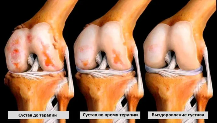 Состояние сустава: до терапии, во время курса, после восстановления